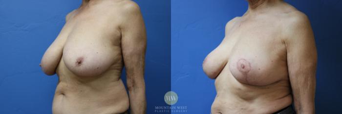 Before & After Breast Reduction Case 191 Left Oblique View in Kalispell, MT