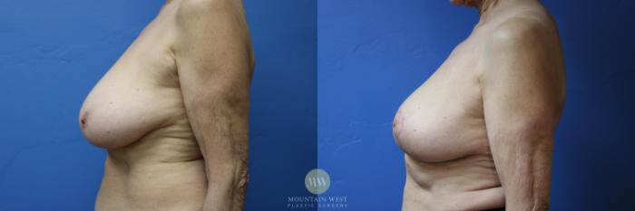 Before & After Breast Reduction Case 191 Left Side View in Kalispell, MT