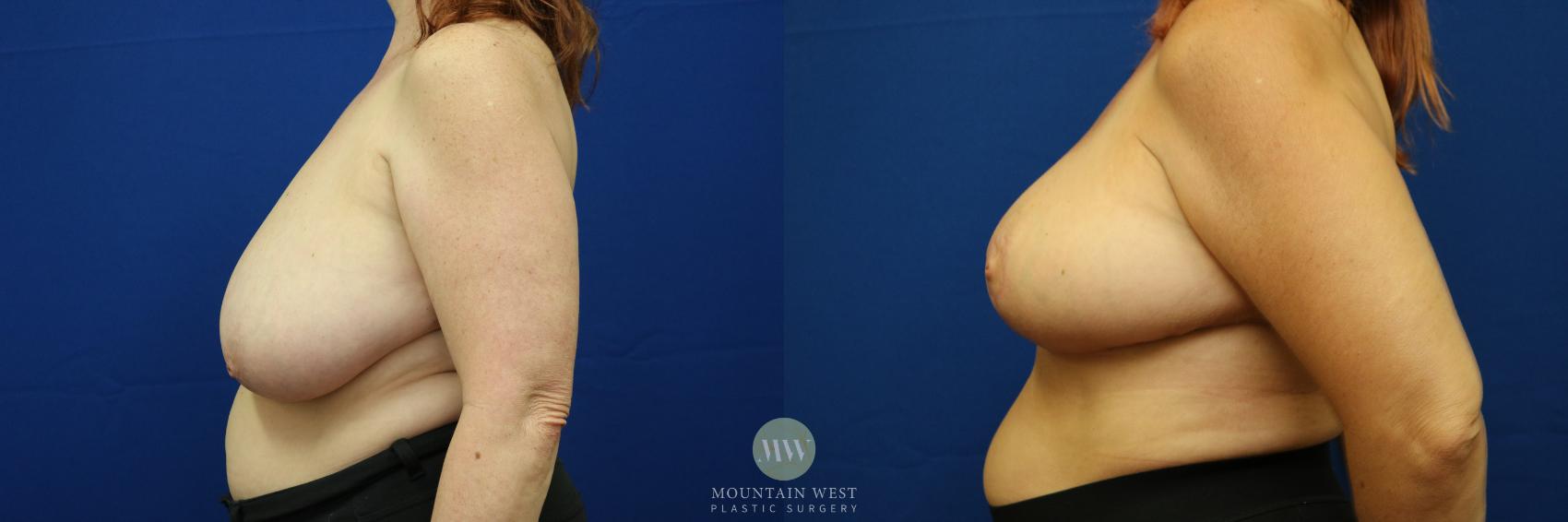 Breast Reduction Case 24 Before & After View #1 | Kalispell, MT | Mountain West Plastic Surgery