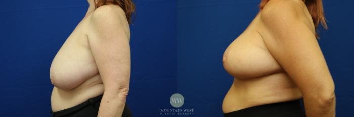 Before & After Breast Reduction Case 24 View #1 View in Kalispell, MT