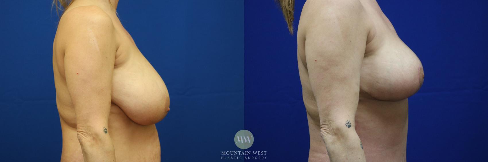 Breast Reduction Case 32 Before & After View #1 | Kalispell, MT | Mountain West Plastic Surgery