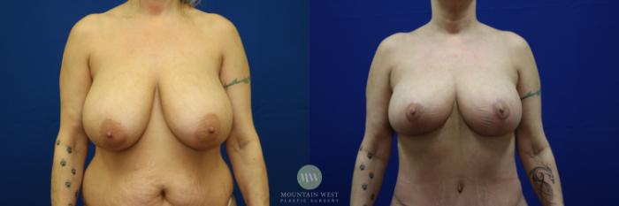 Before & After Breast Reduction Case 32 View #3 View in Kalispell, MT