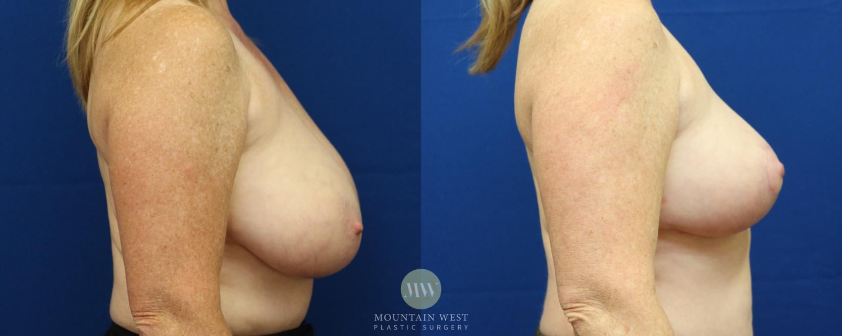 Breast Reduction Case 40 Before & After View #1 | Kalispell, MT | Mountain West Plastic Surgery