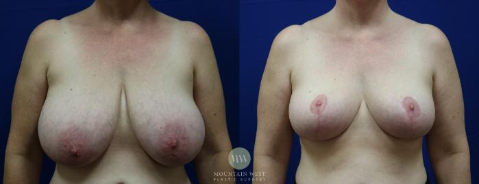 Before & After Breast Reduction Case 44 View #1 View in Kalispell, MT