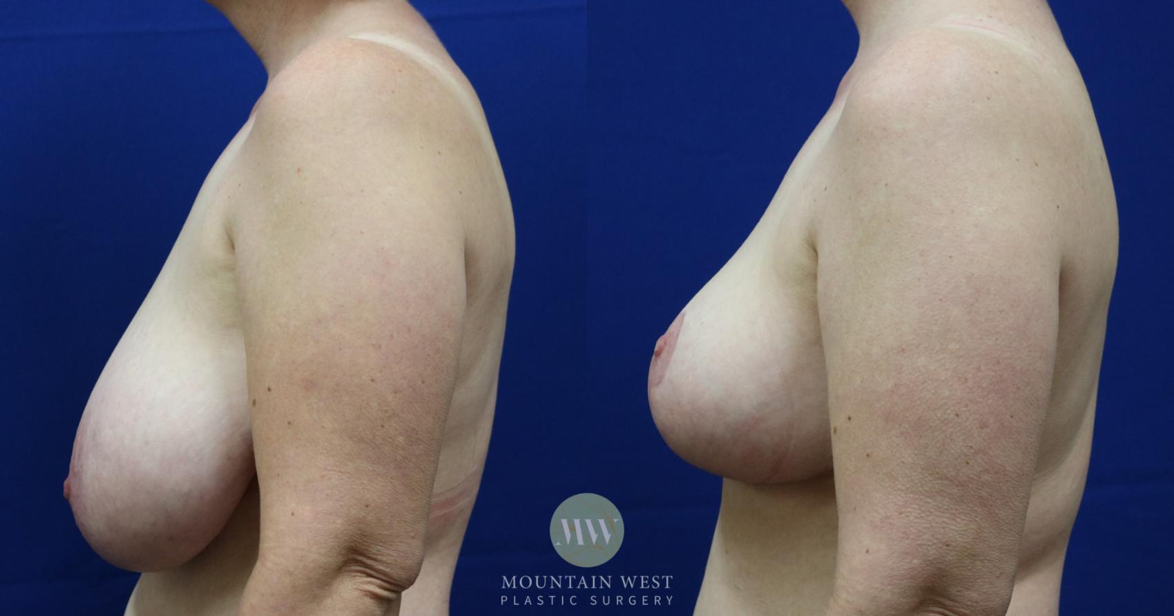 Breast Reduction Case 44 Before & After View #2 | Kalispell, MT | Mountain West Plastic Surgery