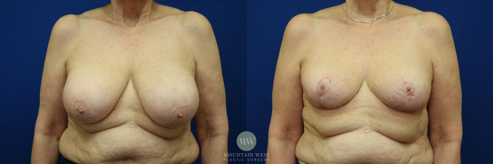 Breast Reduction Case 55 Before & After View #1 | Kalispell, MT | Mountain West Plastic Surgery