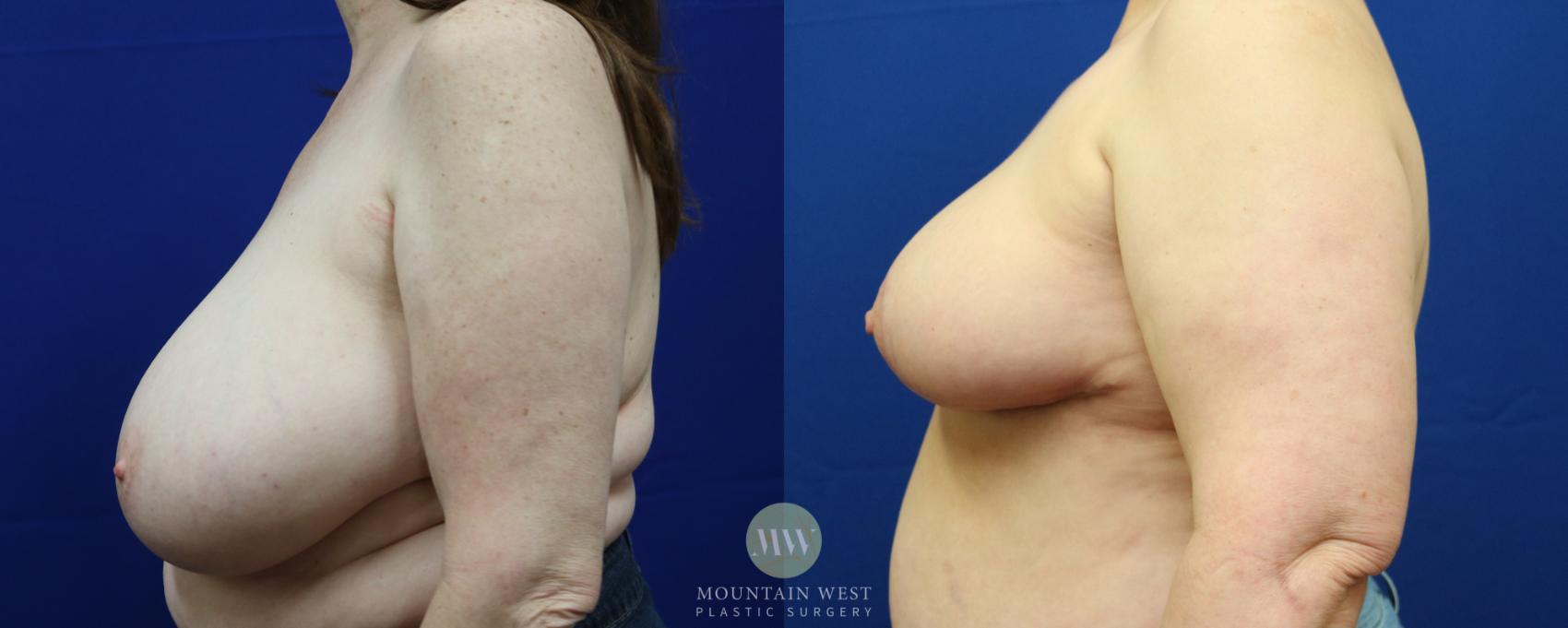Before & After Breast Reduction Case 61 View #1 View in Kalispell, MT