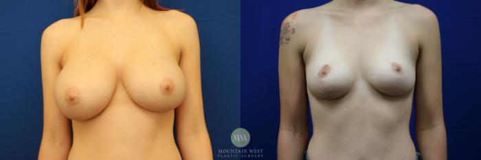 Before & After Breast Reduction Case 64 View #1 View in Kalispell, MT