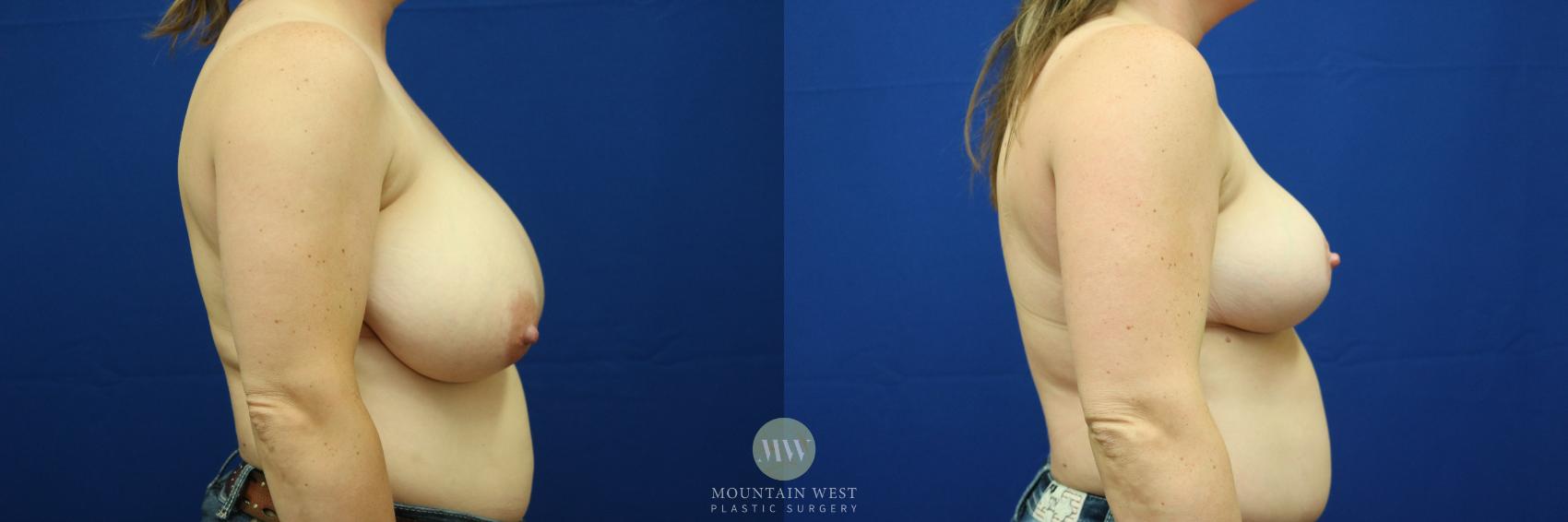 Breast Reduction Case 67 Before & After View #1 | Kalispell, MT | Mountain West Plastic Surgery