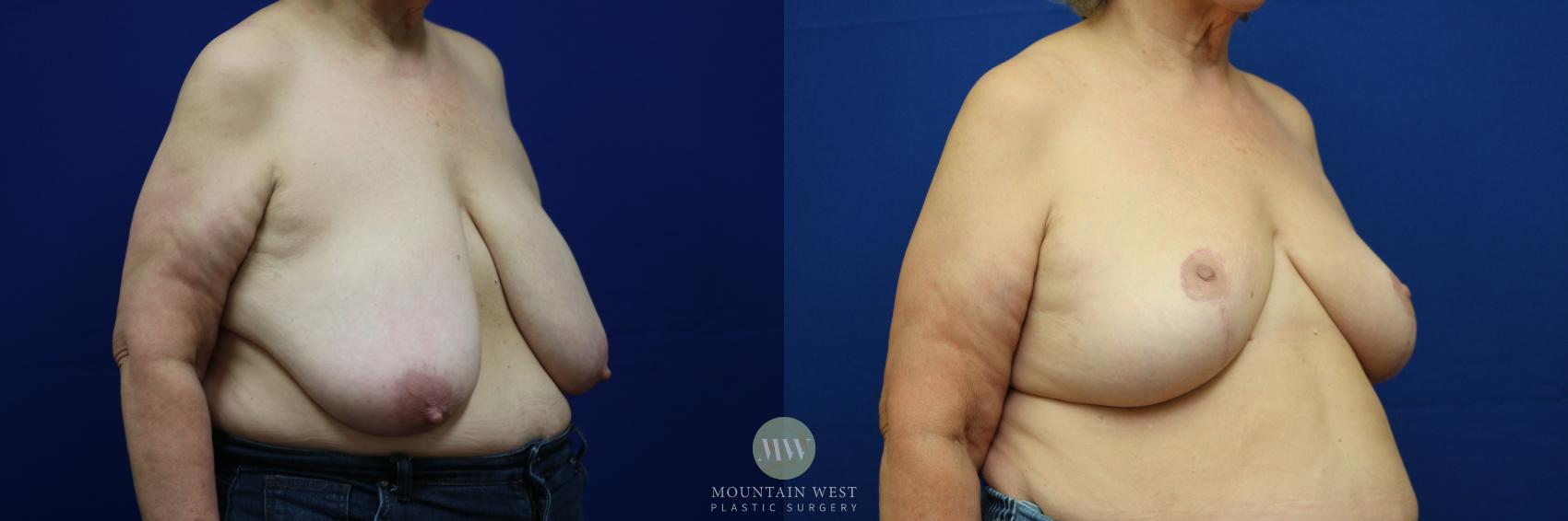 Breast Reduction Case 70 Before & After View #1 | Kalispell, MT | Mountain West Plastic Surgery