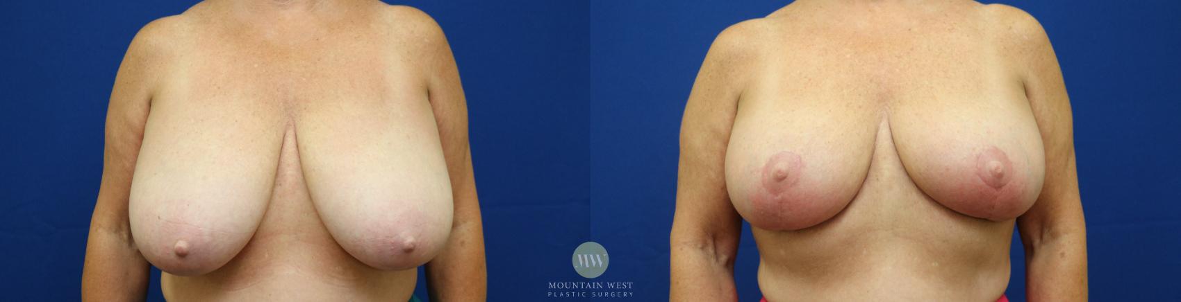 Breast Reduction Case 79 Before & After View #1 | Kalispell, MT | Mountain West Plastic Surgery
