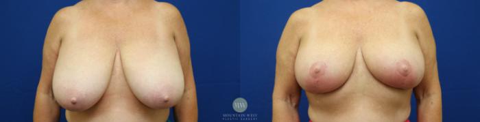 Before & After Breast Reduction Case 79 View #1 View in Kalispell, MT