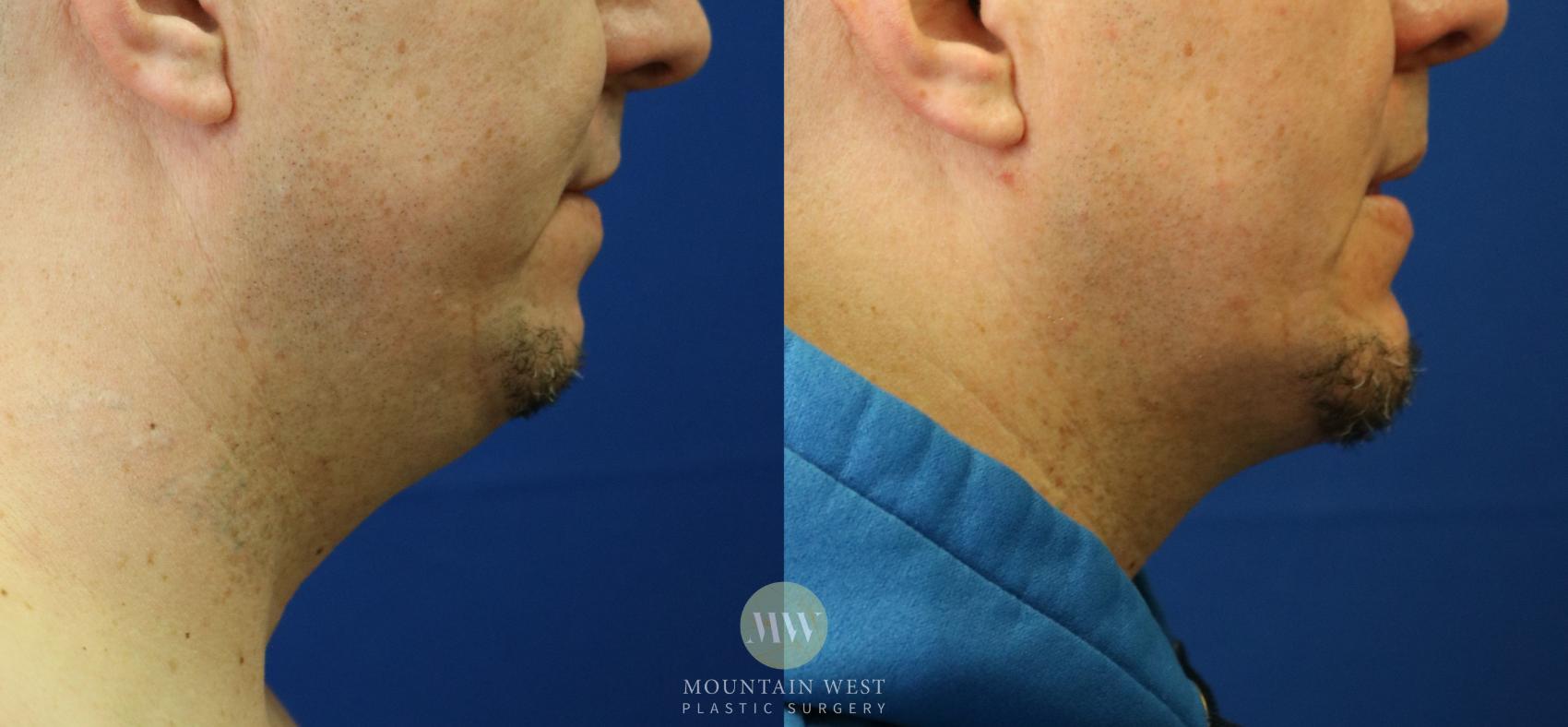 Chin Augmentation with Implant Case 68 Before & After View #1 | Kalispell, MT | Mountain West Plastic Surgery