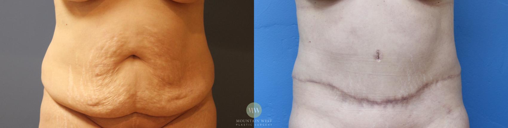 Before & After Drainless tummy tuck Case 158 Front View in Kalispell, MT