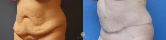 Before & After Liposuction Case 158 Left Oblique View in Kalispell, MT