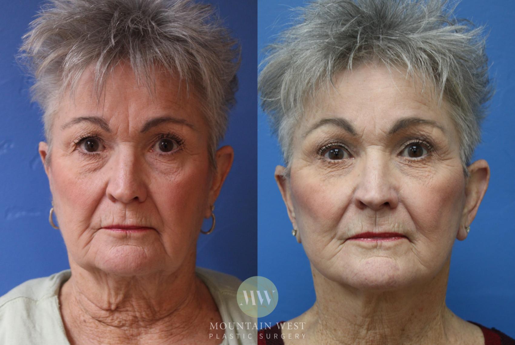 Before & After Facelift Case 190 Front View in Kalispell, MT