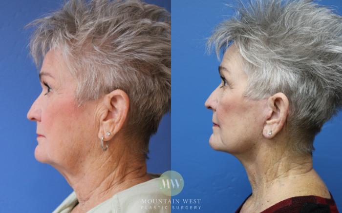 Before & After Facelift Case 190 Left Side View in Kalispell, MT