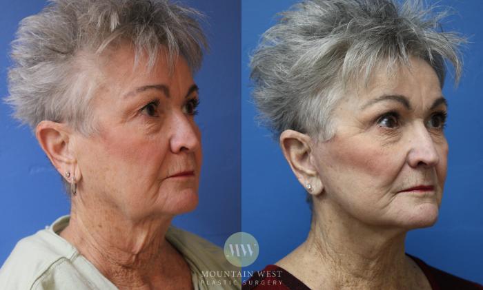 Before & After Facelift Case 190 Right Oblique View in Kalispell, MT