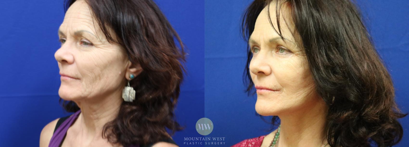 Facelift Case 50 Before & After View #1 | Kalispell, MT | Mountain West Plastic Surgery