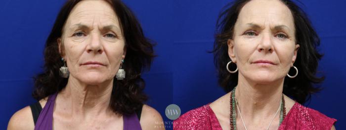 Before & After Facelift Case 50 View #2 View in Kalispell, MT