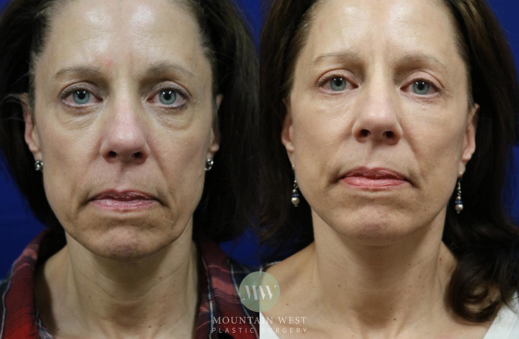 Facelift Case 65 Before & After View #1 | Kalispell, MT | Mountain West Plastic Surgery