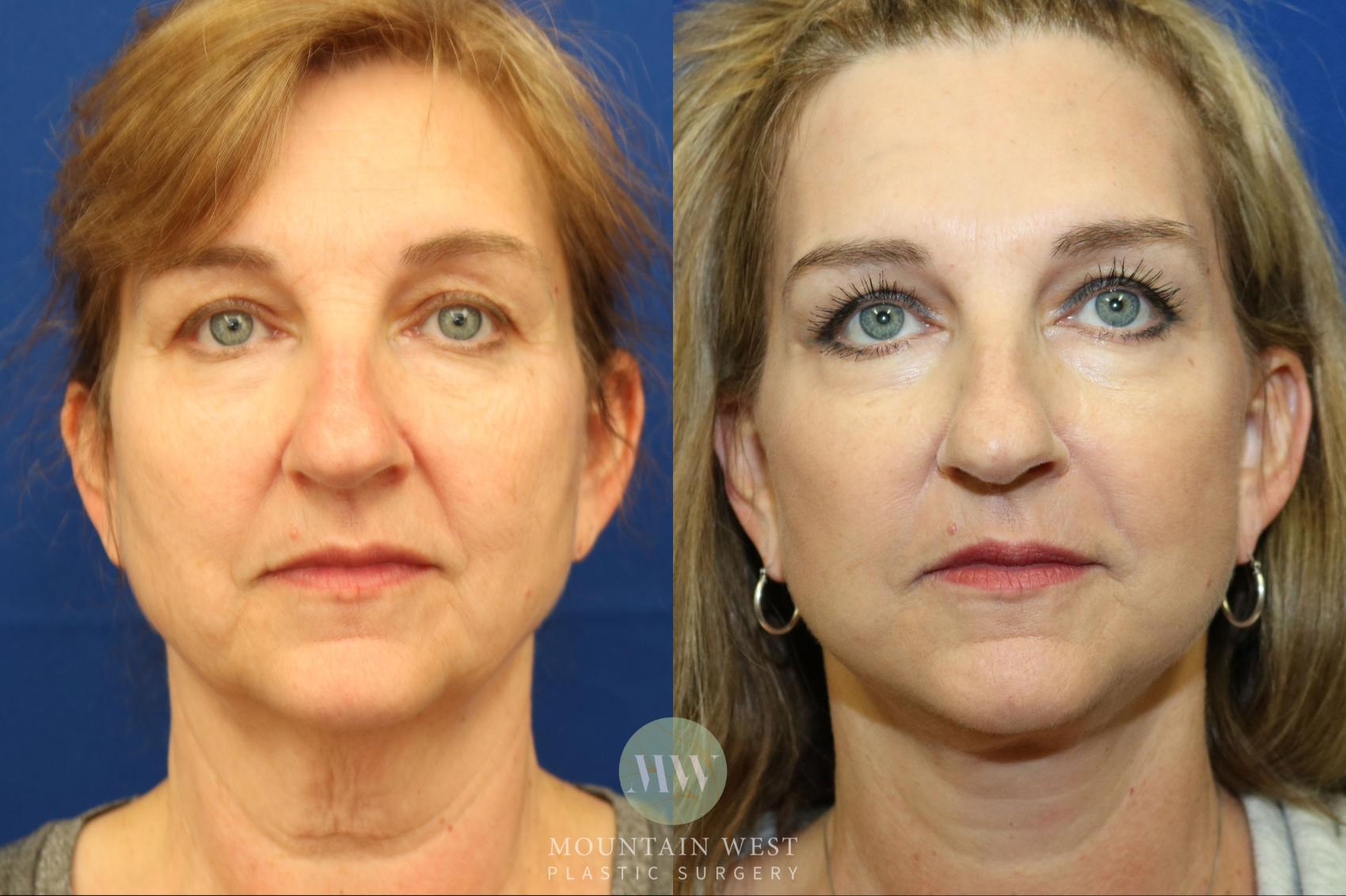 Facelift Case 8 Before & After View #1 | Kalispell, MT | Mountain West Plastic Surgery