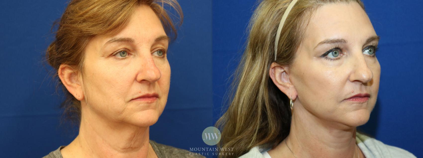Facelift Case 8 Before & After View #2 | Kalispell, MT | Mountain West Plastic Surgery
