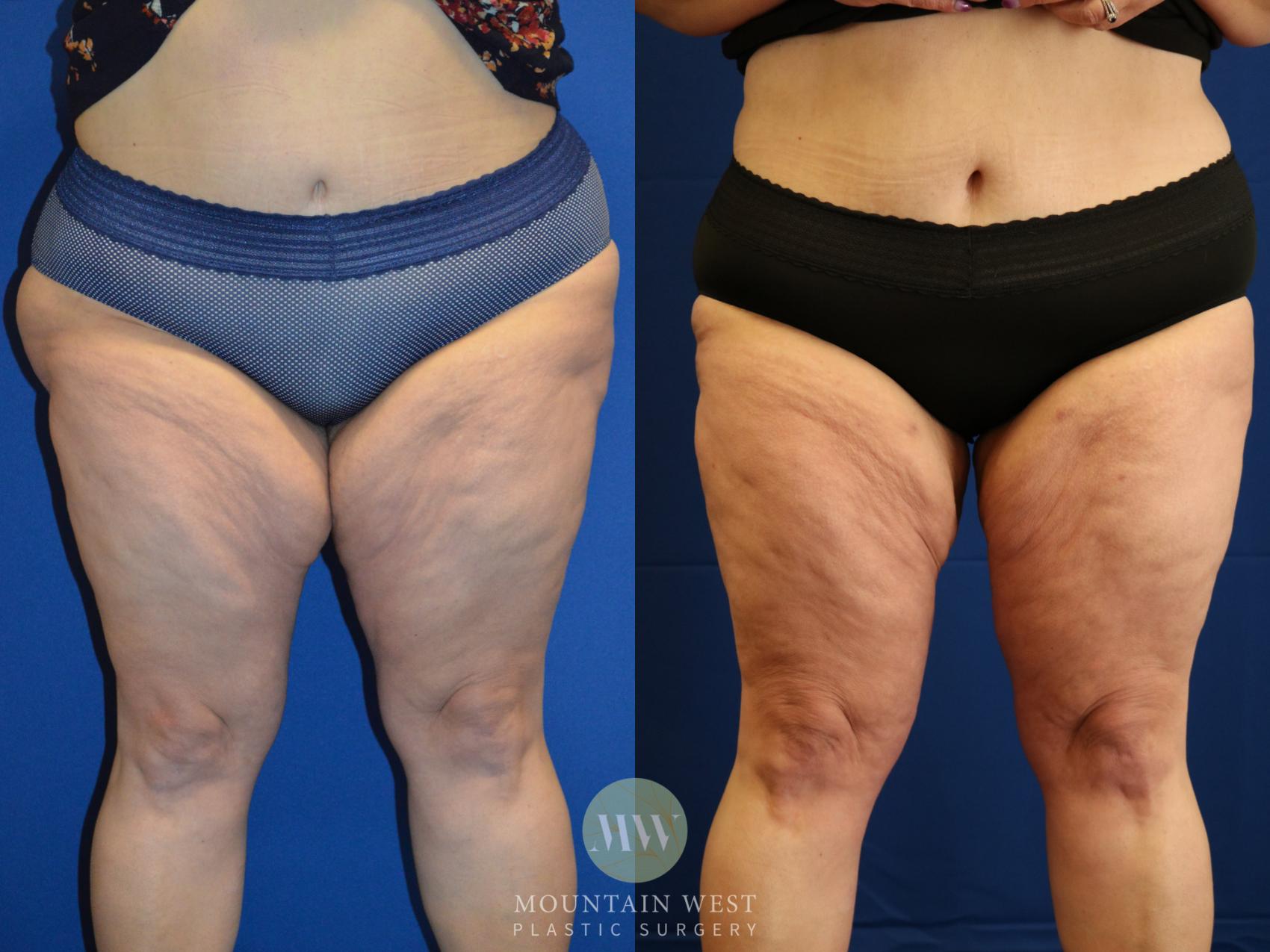 Before & After Liposuction Case 103 Front View in Kalispell, MT