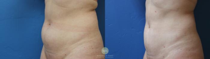 Before & After Liposuction Case 181 Left Oblique View in Kalispell, MT