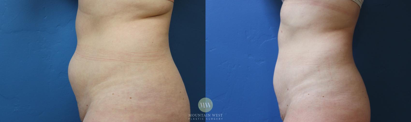 Before & After Liposuction Case 181 Left Side View in Kalispell, MT