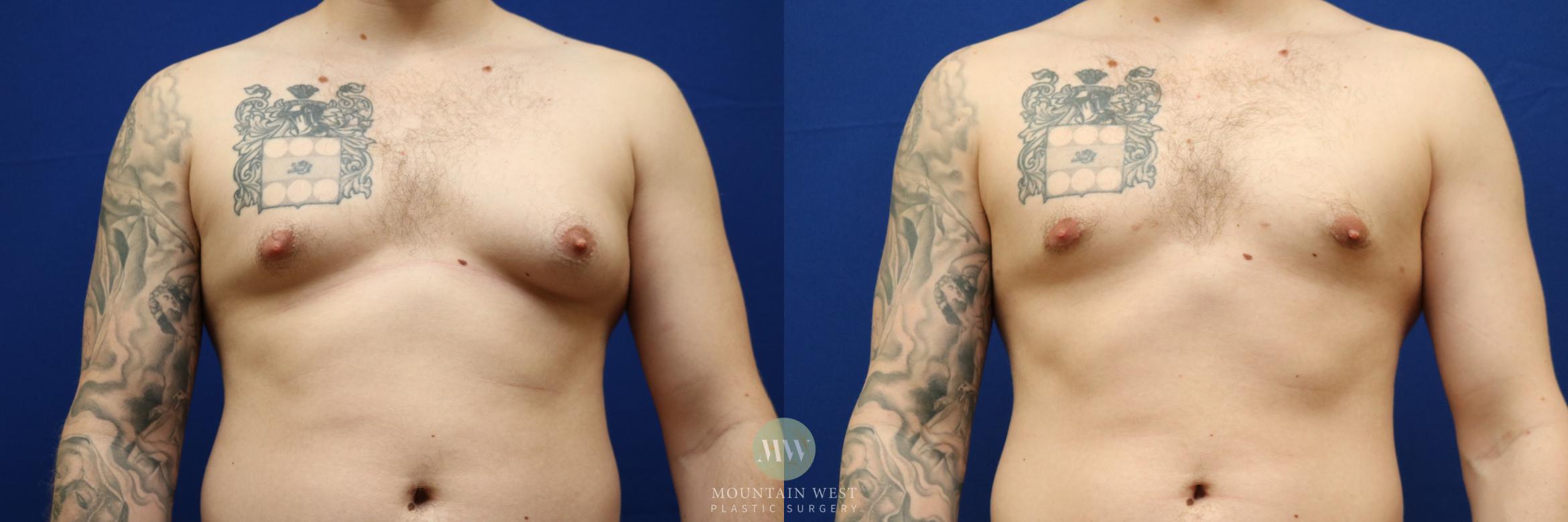 Male Breast Reduction  Case 122 Before & After Front | Kalispell, MT | Mountain West Plastic Surgery