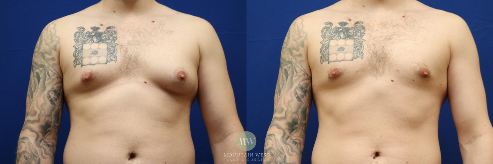 Before & After Male Breast Reduction / Gynecomastia Case 122 Front View in Kalispell, MT