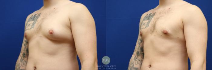 Before & After Male Breast Reduction / Gynecomastia Case 122 Left Oblique View in Kalispell, MT