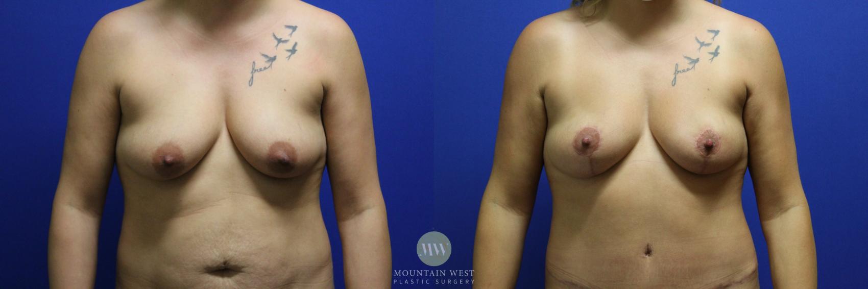 Before & After Liposuction Case 115 Front View in Kalispell, MT