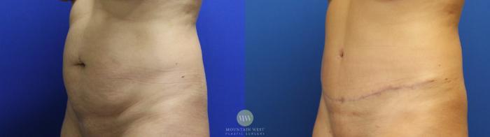 Before & After Breast Lift Case 115 Left Oblique View in Kalispell, MT