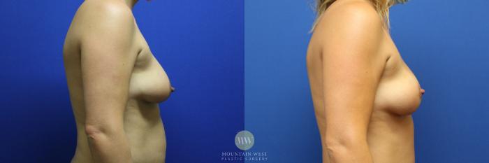 Before & After Breast Lift Case 115 Right Side Breasts View in Kalispell, MT