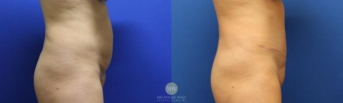 Before & After Liposuction Case 115 Right Side View in Kalispell, MT