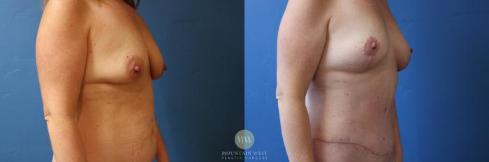 Before & After Mommy Makeover Case 196 Right Oblique View in Kalispell, MT