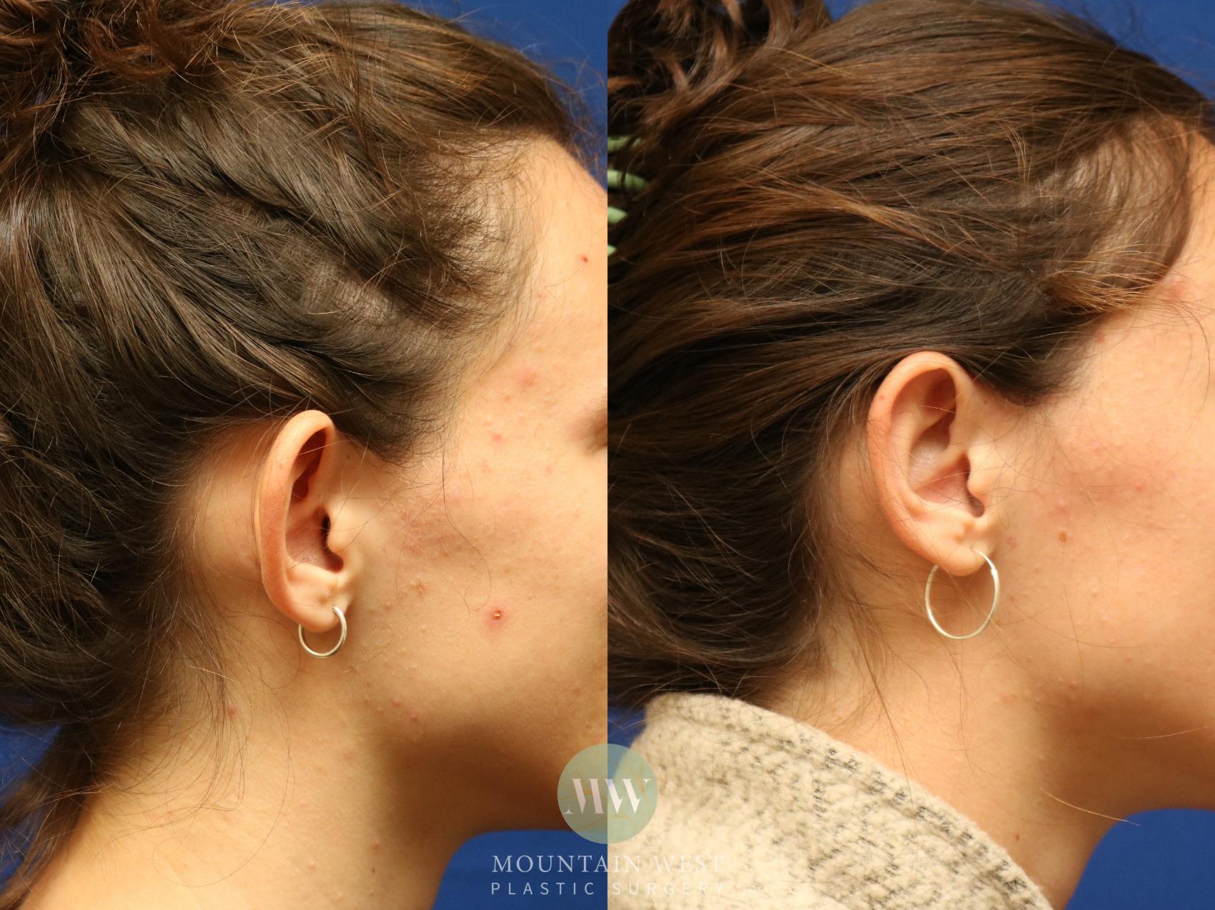Before & After Otoplasty  Case 97 Right Side View in Kalispell, MT