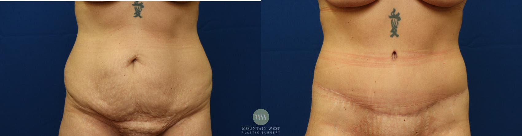 Tummy Tuck Case 101 Before & After Front | Kalispell, MT | Mountain West Plastic Surgery