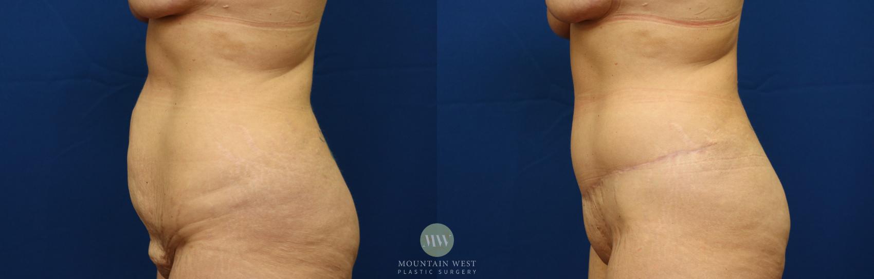 Before & After Tummy Tuck Case 101 Left Side View in Kalispell, MT