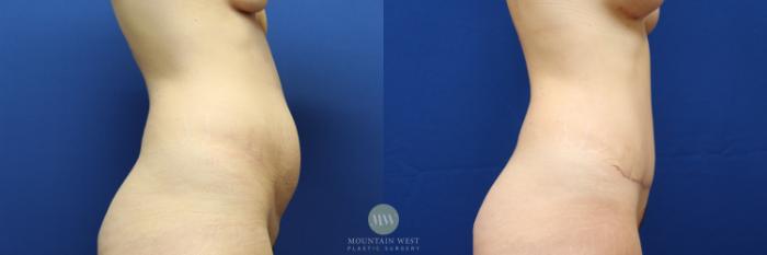 Before & After Tummy Tuck Case 104 Right Side View in Kalispell, MT
