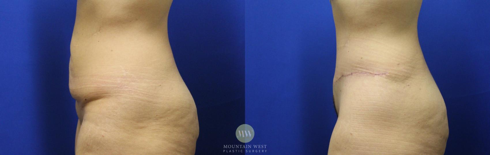 Tummy Tuck Case 114 Before & After Left Side | Kalispell, MT | Mountain West Plastic Surgery