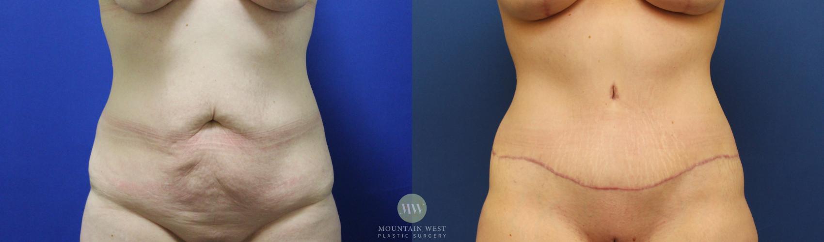 Tummy Tuck Case 144 Before & After Front | Kalispell, MT | Mountain West Plastic Surgery