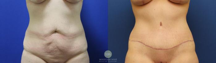 Before & After Tummy Tuck Case 144 Front View in Kalispell, MT