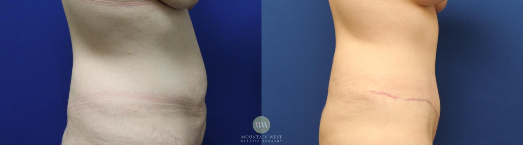 Tummy Tuck Case 144 Before & After Right Side | Kalispell, MT | Mountain West Plastic Surgery