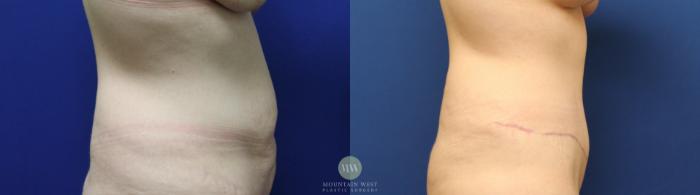 Before & After Tummy Tuck Case 144 Right Side View in Kalispell, MT