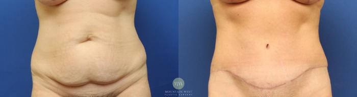 Before & After Tummy Tuck Case 149 Front View in Kalispell, MT