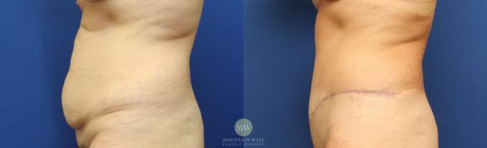 Before & After Tummy Tuck Case 149 Left Side View in Kalispell, MT