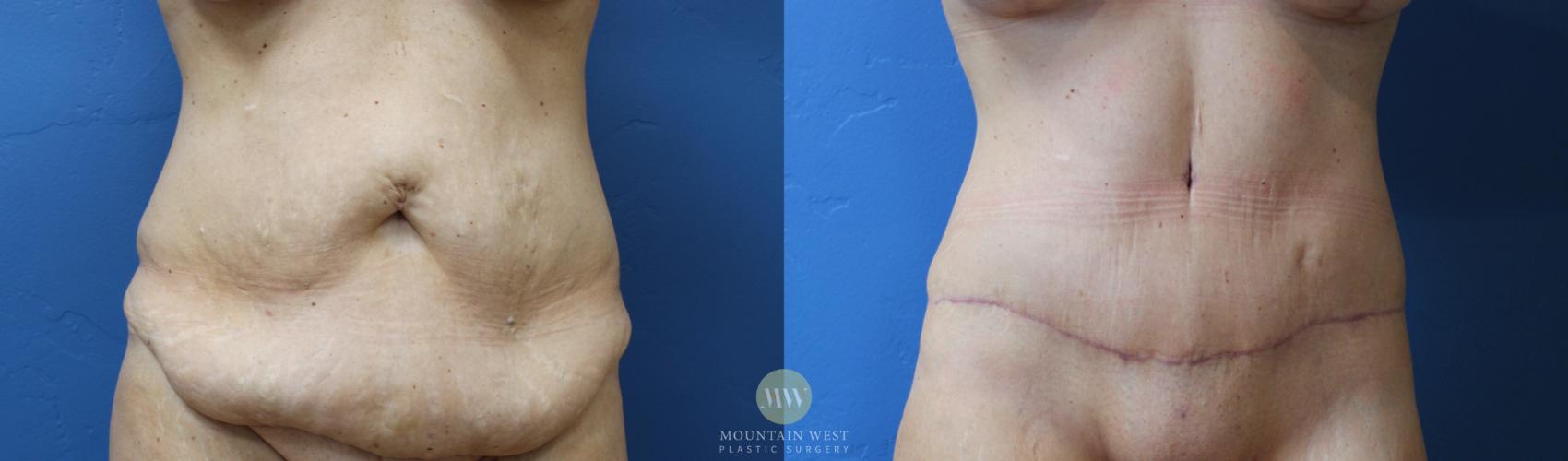 Before & After Tummy Tuck Case 153 Front View in Kalispell, MT